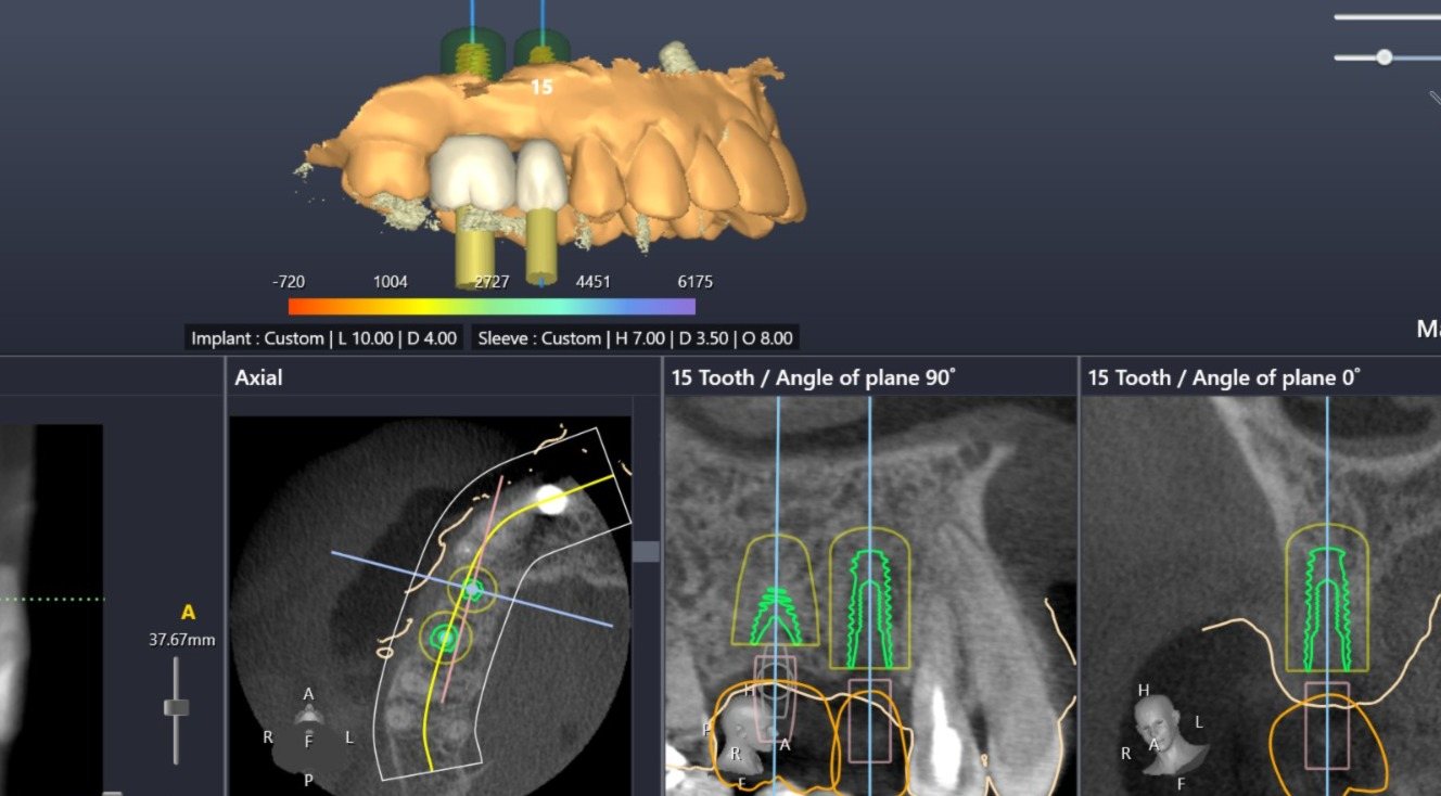 Digital implant planning: a CBCT scan aligned with a 3D intraoral scan to plan implant position