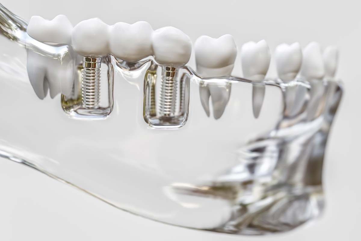 Anatomical model showing two dental implants integrated among natural teeth