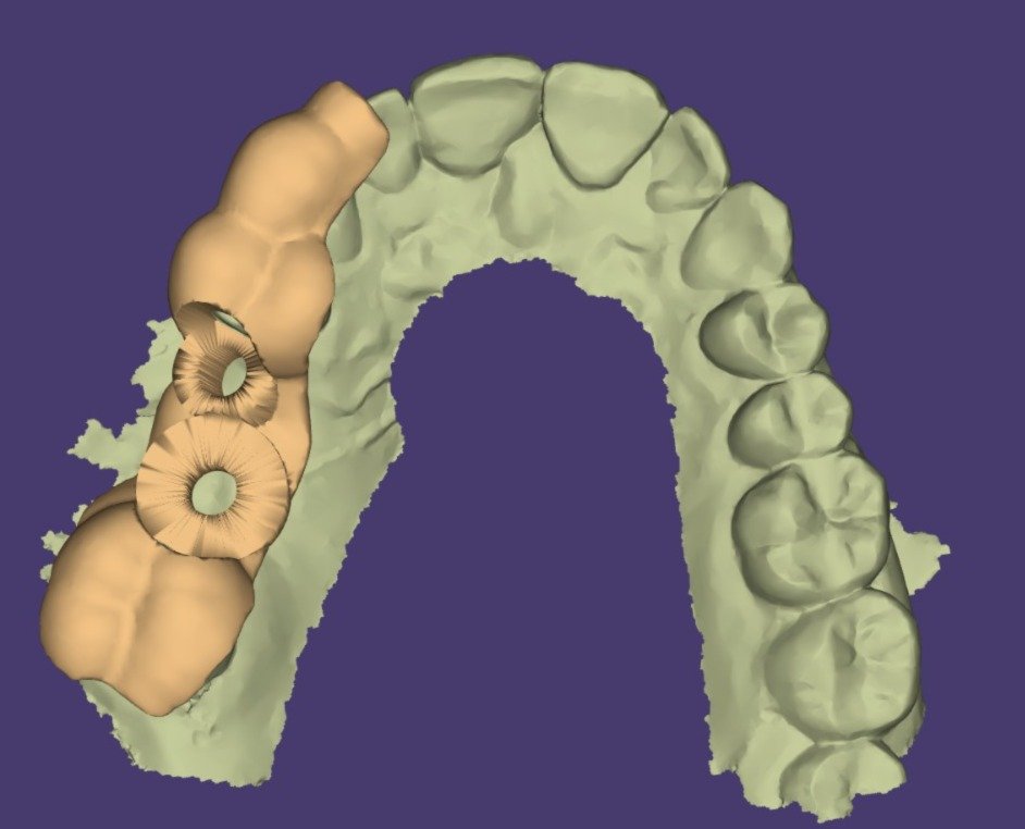 3D-designed surgical guide for precise implant placement, based on the same case